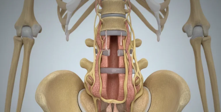 Medicinski prikaz zožitve hrbteničnega kanala ali spinalne stenoze v ledvenem delu hrbtenice z vidnimi živci.