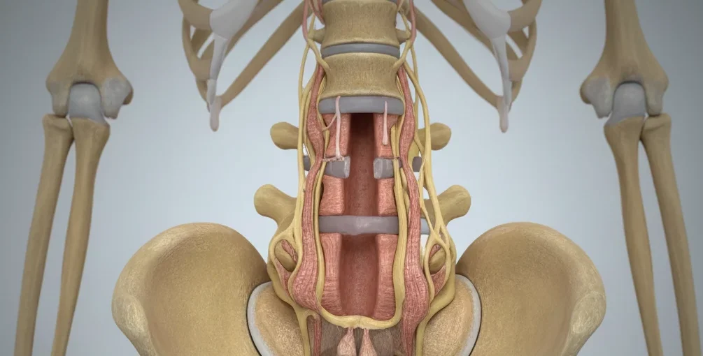 Medicinski prikaz zožitve hrbteničnega kanala ali spinalne stenoze v ledvenem delu hrbtenice z vidnimi živci.
