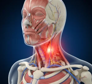 3D anatomski prikaz vratu z označenim vnetjem živcev in mišic, ki povzročajo bolečino.