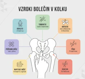 Infografika najpogostejših vzrokov za bolečine v kolku: bursitis, tendinitis, artritis, išias in poškodbe mišic.