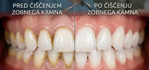 Primerjava zob pred in po čiščenju zobnega kamna