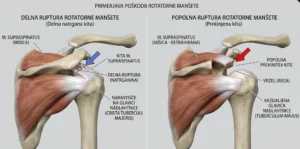 Primerjava delne in polne rupture rotatorne manšete
