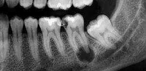 RTG zob s prikazom granuloma na korenini