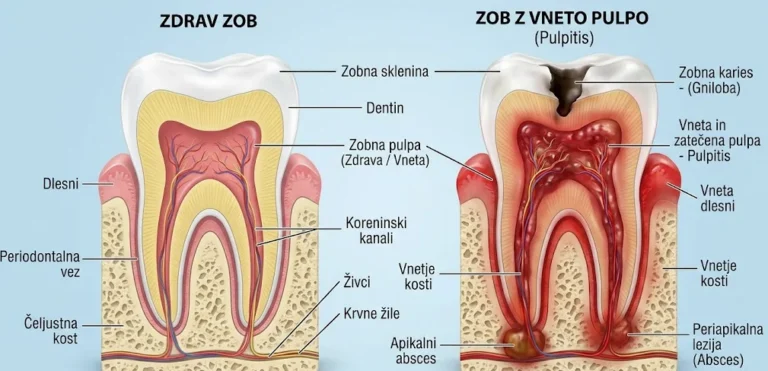 Primerjava zdravega zoba in zoba z vnetjem zobnega živca