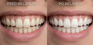Primerjava nasmeha pred in po beljenju zob