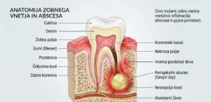 3D prikaz vnetja zoba z abscesom