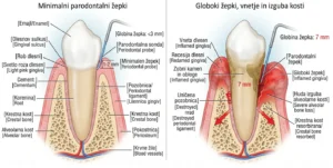 zdrave dlesni vs parodontalna bolezen zobni žepki