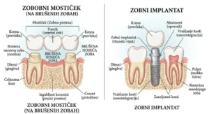 primerjava zobni mostiček in zobni implantat prikaz razlik v zobozdravstvu